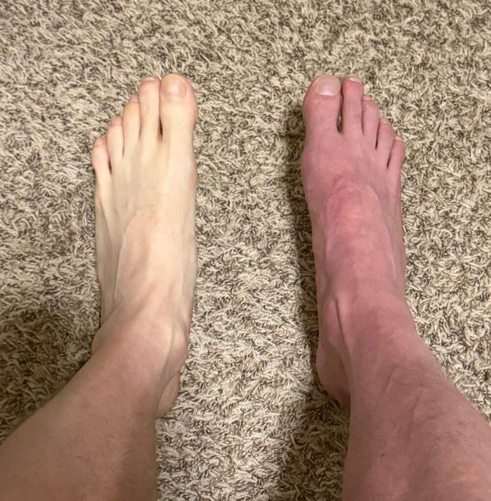 Gout symptoms can be very painful