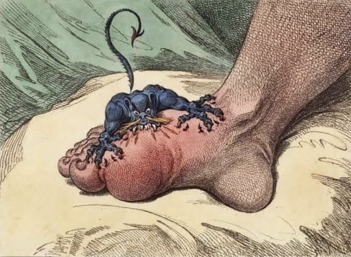 How to Cure Gout: What Really Works
