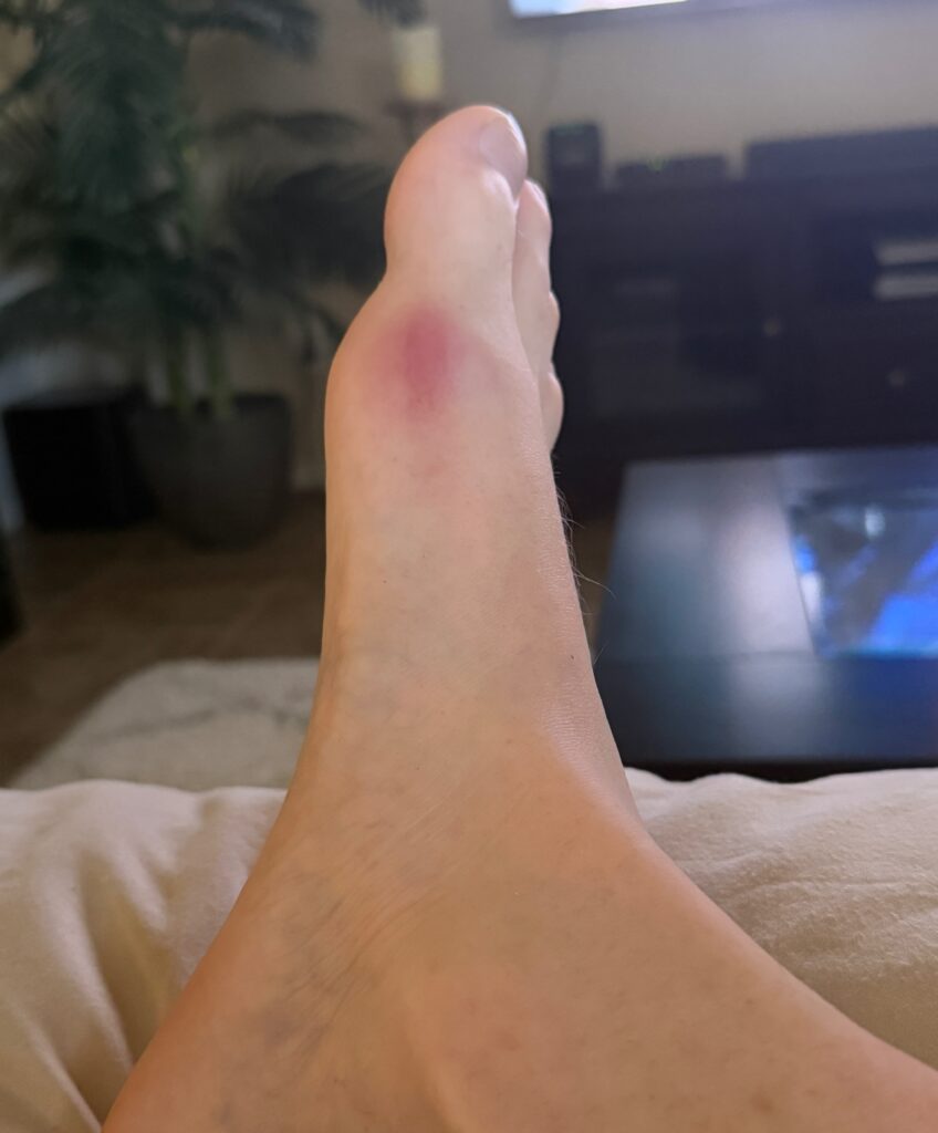 How to cure gout